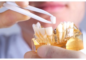 Протезирование зубов в рассрочку